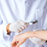 Ectima, infecția pielii care poate lăsa cicatrici. De ce apare și cum se tratează corect