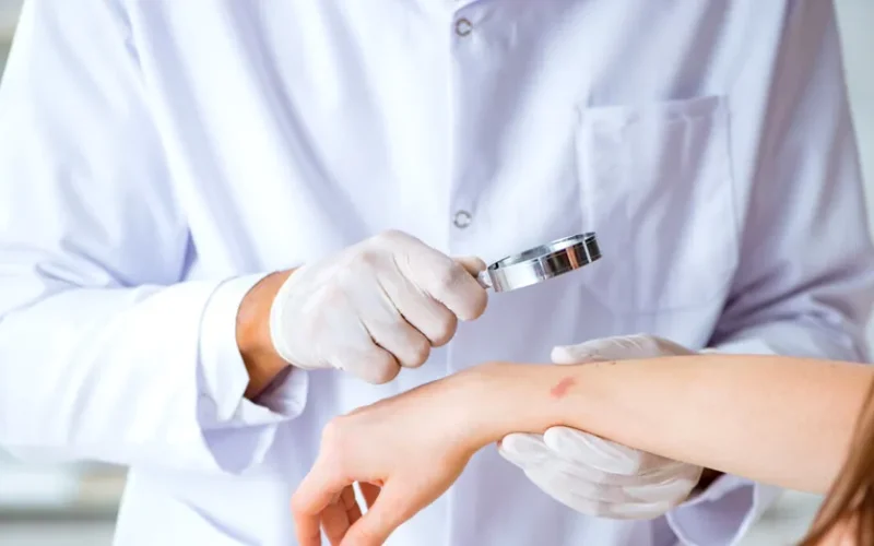 Ectima, infecția pielii care poate lăsa cicatrici. De ce apare și cum se tratează corect